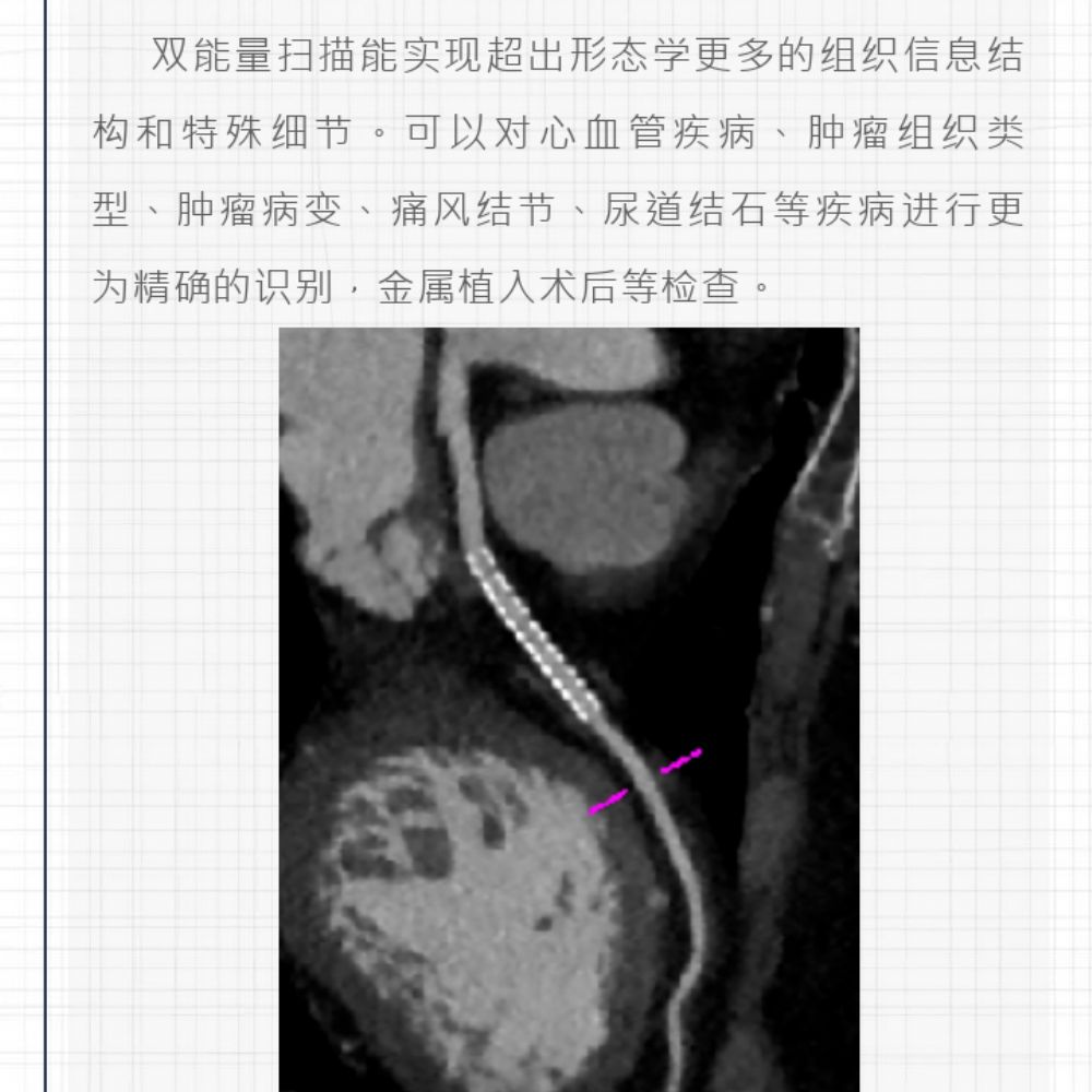 智慧诊疗，影像先行——曹县磐石医院开创CT安全筛查新时代