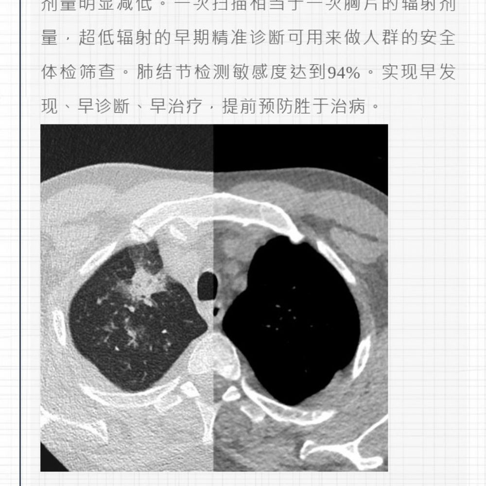 智慧诊疗，影像先行——曹县磐石医院开创CT安全筛查新时代